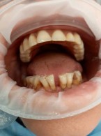 SPECJALISTA RADZI: Unieruchomienie zębów szyną z włókna szklanego w chorobie przyzębia