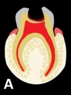Amputacja miazgi w zębach mlecznych z użyciem siarczanu żelaza