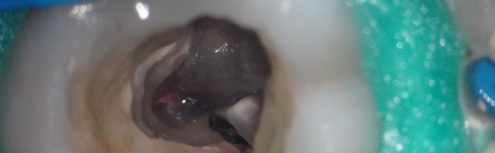 Złożoność systemu kanałowego pierwszego zęba trzonowego szczęki