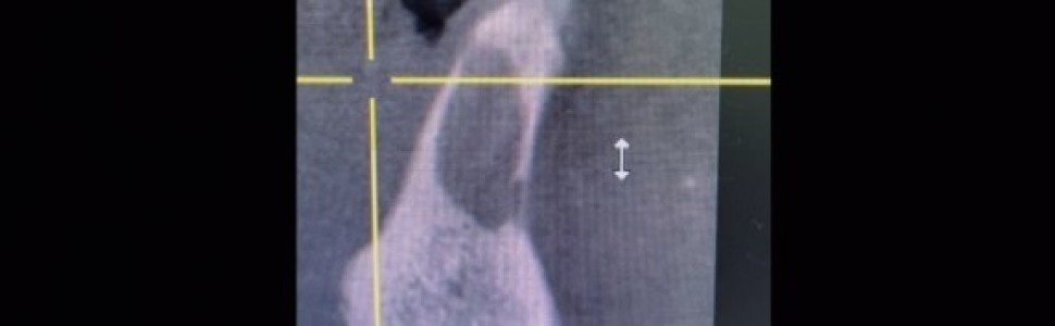 Wielowizytowe leczenie endodontyczne zębów 31 i 41 z przewlekłymi zmianami okołowierzchołkowymi