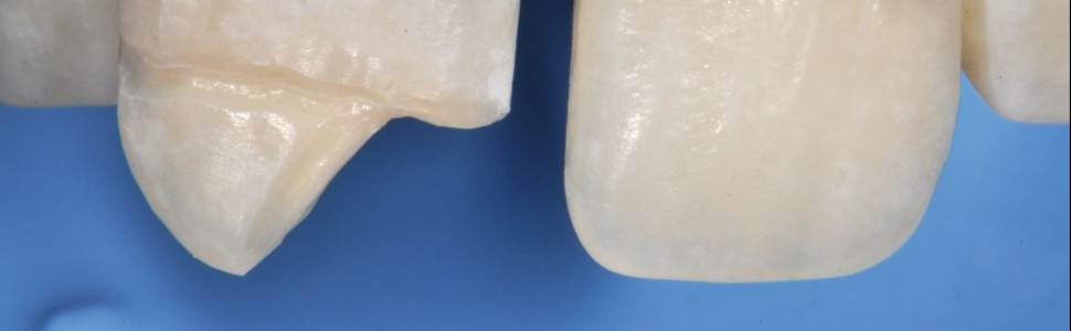 Technika dwuwarstwowa po urazach zębów przednich