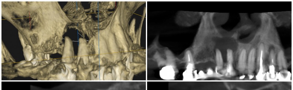  Leczenie endodontyczne zęba 12  i 11  z rozległą zmianą okołowierzchołkową