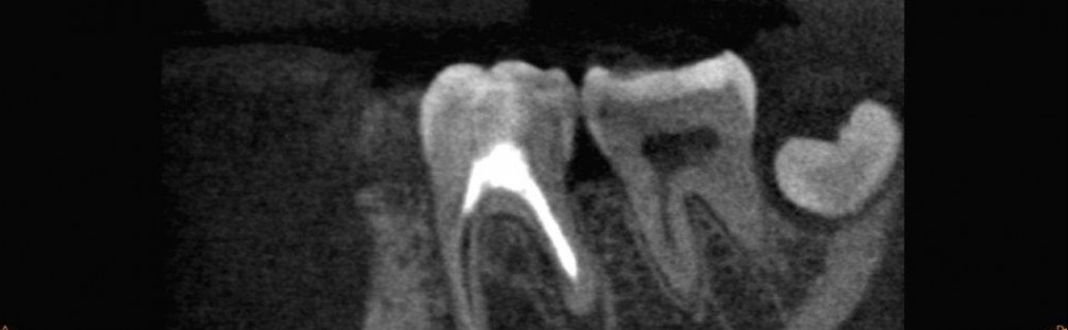 Wieloseansowe leczenie endodontyczne