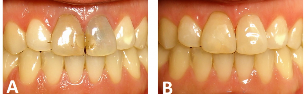 Część 3. Wybielanie przebarwionych zębów bezmiazgowych. Nietypowe przypadki i powikłania.