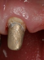 Wybór metody odbudowy zębów przednich po leczeniu endodontycznym