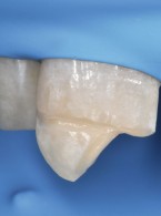 Technika dwuwarstwowa po urazach zębów przednich