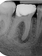 Leczenie endodontyczne czterokanałowego pierwszego zęba trzonowego żuchwy 