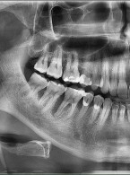 Kompleksowa diagnostyka periodontologiczna: od wywiadu lekarskiego po badanie kliniczne 